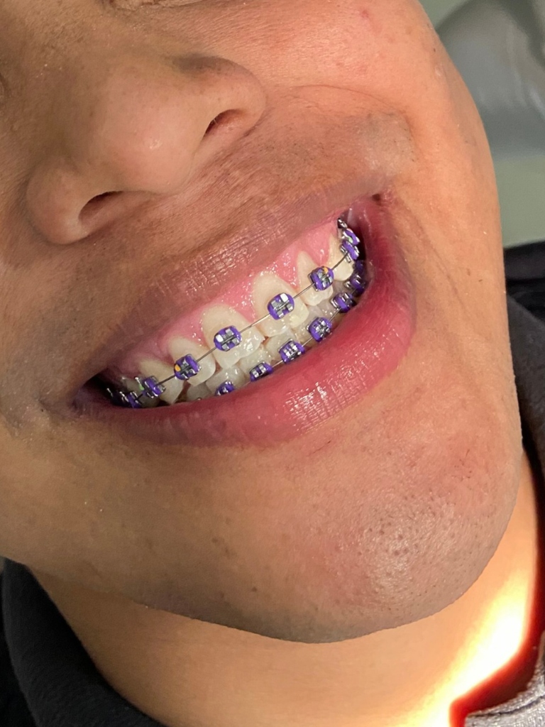 Dentes alinhados com aparelho ortodôntico